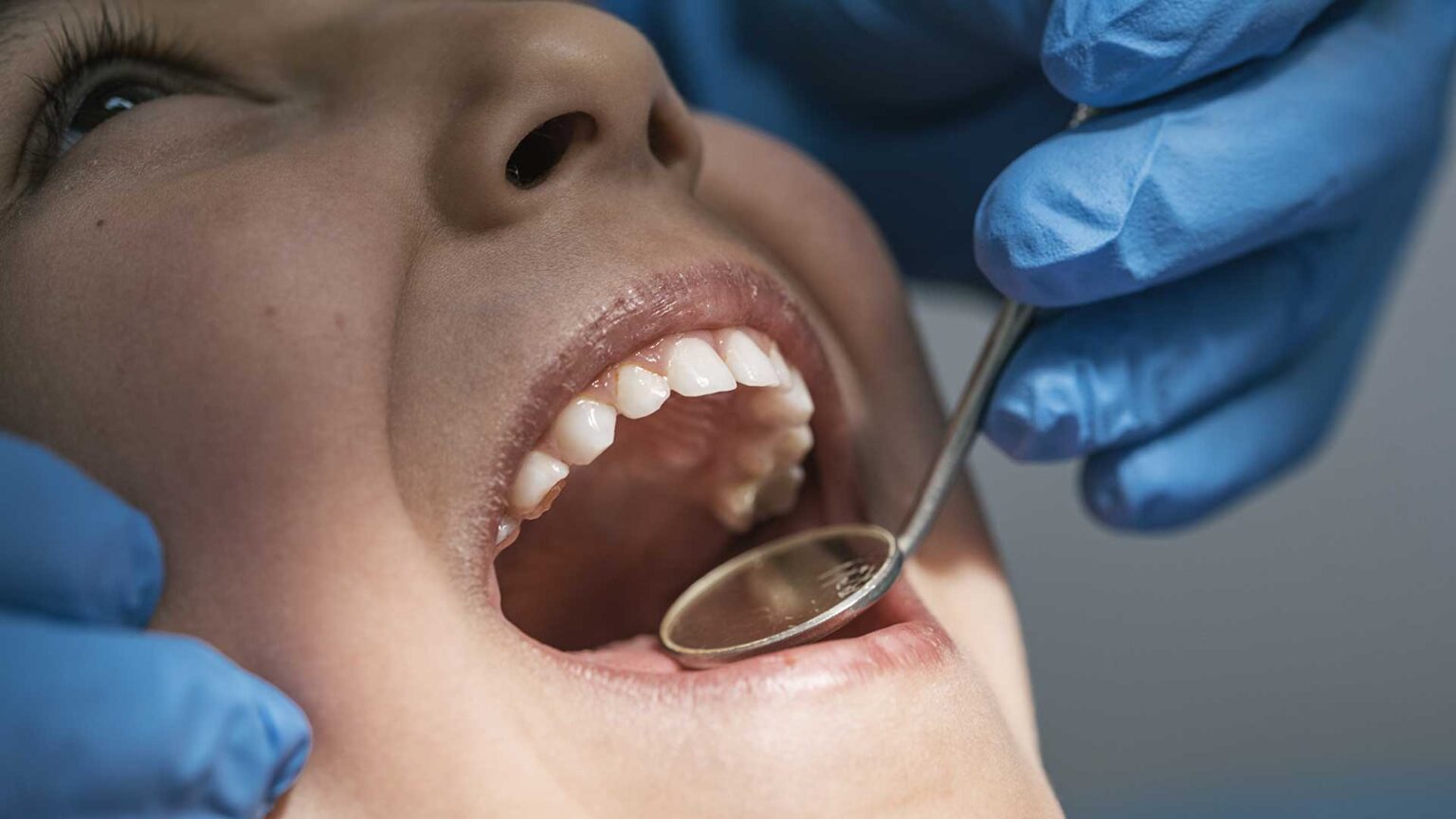 ¿Cómo combatir la placa y el sarro? Marín Lozano Dentistas